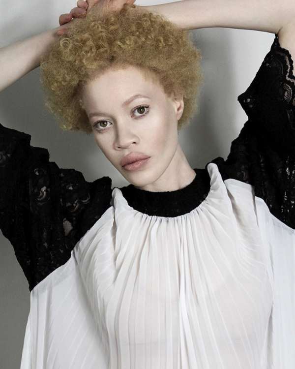 Афроамериканка-альбинос